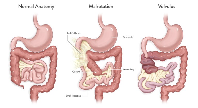 What is Intestinal Malrotation? – Intestinal Malrotation Research Alliance